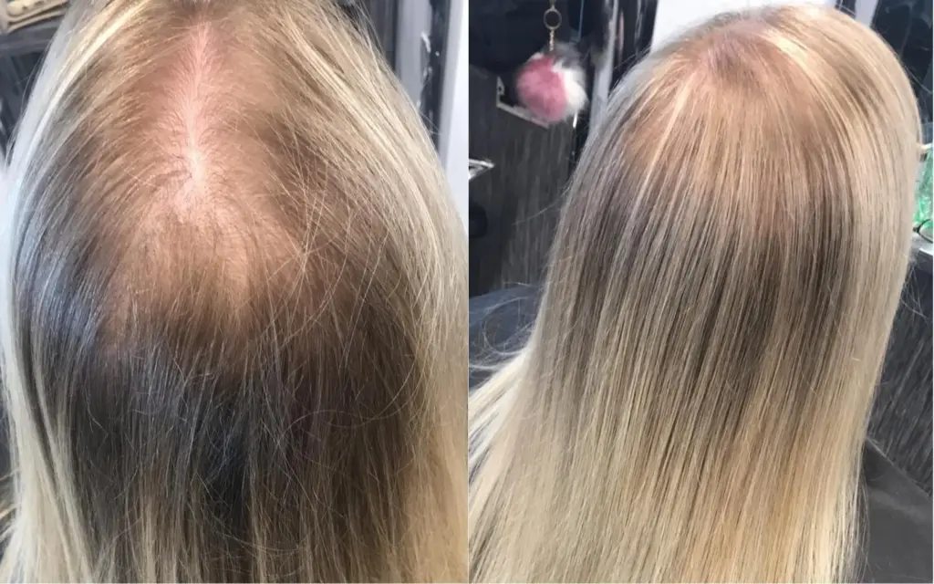 Female Hair Thinning & HRT: What Science Tells Us