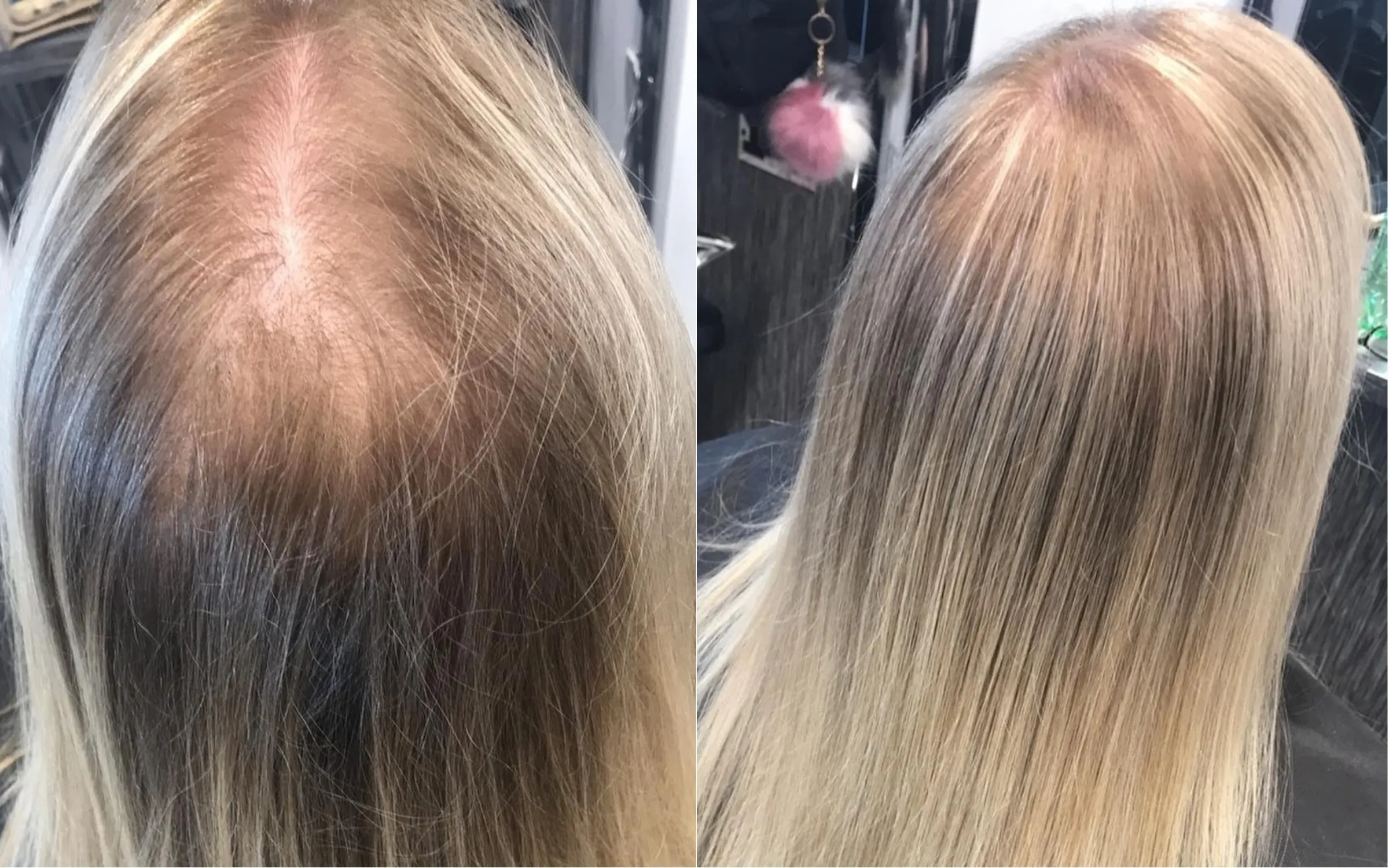 Female Hair Thinning & HRT: What Science Tells Us
